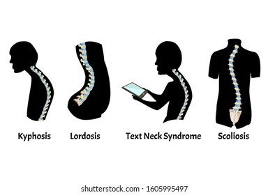 The position of the spine with lordosis, kyphosis. Text Neck Syndrome. Spinal curvature, kyphosis, lordosis, scoliosis, arthrosis. Poor posture and slouching. Infographics. Vector illustration.