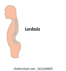 1,411 Lordosis Images, Stock Photos & Vectors | Shutterstock