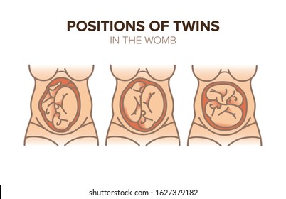 Position of twins in the womb. Pregnancy illustration for your design