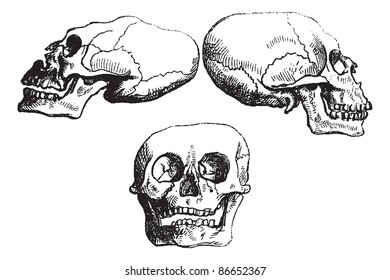 Positional plagiocephaly or Deformational plagiocephaly or flathead syndrome, vintage engraved illustration. Trousset encyclopedia (1886 - 1891).