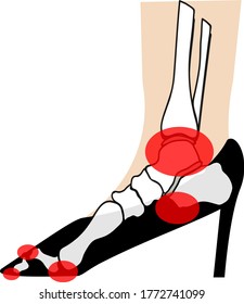 Positioning the foot in a high-heel shoe