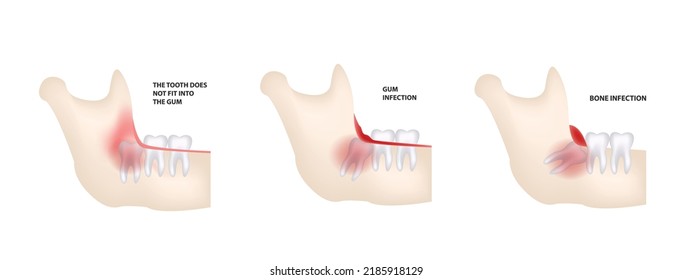 possible problems due to wisdom tooth