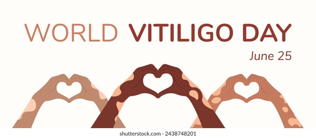 Postcard, poster in flat style. June 25 is World Vitiligo Day. Woman in white t-shirt, heart-shaped hands, skin with lost pigment. Vector illustration EPS10
