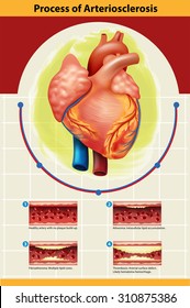 Poster of Arteriosclerosis process  illustration
