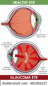 Poster with comparative information in how to identify a healthy eye and other with glaucoma disease.