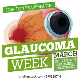 Poster for Glaucoma Week with propaganda for prevention and awareness of this disease with an eyeball and affected optic nerve for high pressure.