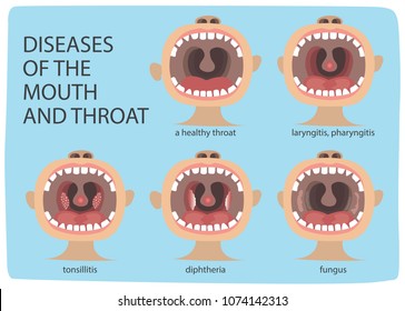 Poster Infographics illustration of a healthy throat difference from tonsillitis
