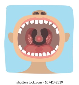 Poster Infographics illustration of a healthy throat difference from tonsillitis
