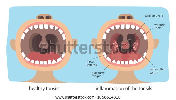 anginas inflamadas in english