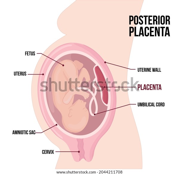 Posterior Placental previa. Usual anatomical\
Placenta Location During Pregnancy. Medical Pathology. detailed\
medical diagram with table of symbols. Colored vector illustration\
isolated on white.