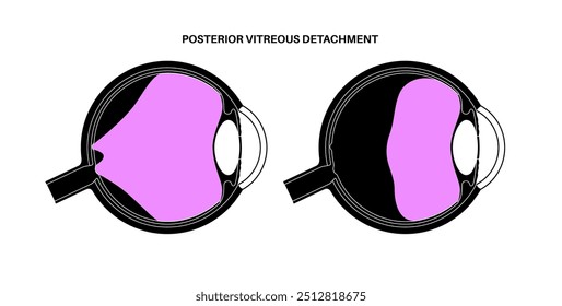 Cartaz anatômico do descolamento do vítreo posterior. O gel no globo ocular humano se separa da retina. Causa moscas volantes ou piscadas de luz. Problemas de retina relacionados à idade ilustração médica do vetor plano.