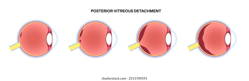 Cartaz anatômico do descolamento do vítreo posterior. O gel no globo ocular humano se separa da retina. Causa moscas volantes ou piscadas de luz. Problemas de retina relacionados à idade ilustração médica do vetor plano.