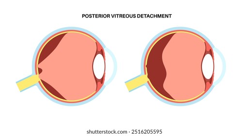 Cartaz anatômico do descolamento do vítreo posterior. O gel no globo ocular humano se separa da retina. Causa moscas volantes ou piscadas de luz. Problemas de retina relacionados à idade ilustração médica do vetor plano.