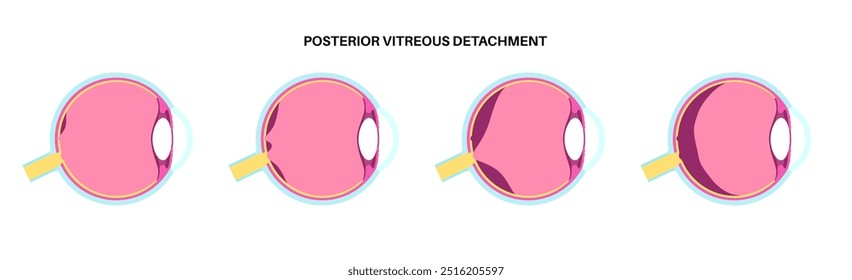 Cartaz anatômico do descolamento do vítreo posterior. O gel no globo ocular humano se separa da retina. Causa moscas volantes ou piscadas de luz. Problemas de retina relacionados à idade ilustração médica do vetor plano.