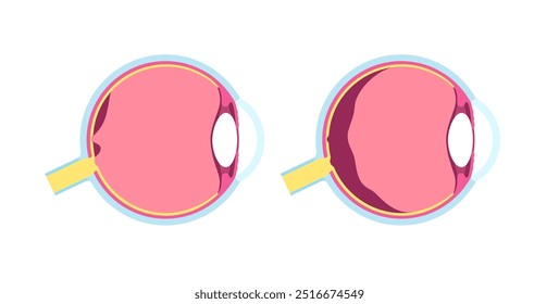 Cartaz anatômico do descolamento do vítreo posterior. O gel no globo ocular humano se separa da retina. Causa moscas volantes ou piscadas de luz. Problemas de retina relacionados à idade ilustração médica do vetor plano.