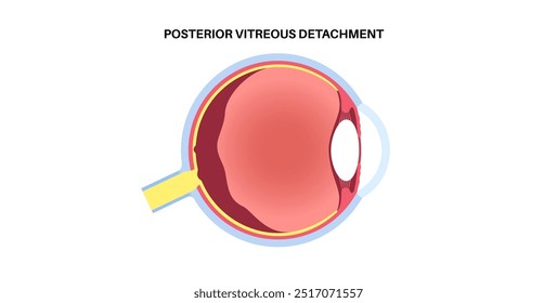 Cartaz anatômico do descolamento do vítreo posterior. O gel no globo ocular humano se separa da retina. Causa moscas volantes ou piscadas de luz. Problemas de retina relacionados à idade ilustração médica do vetor plano.