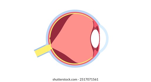 Cartaz anatômico do descolamento do vítreo posterior. O gel no globo ocular humano se separa da retina. Causa moscas volantes ou piscadas de luz. Problemas de retina relacionados à idade ilustração médica do vetor plano.