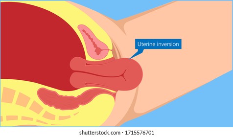 Postpartum Hemorrhage PPH Care Baby Loss Prevent Therapy Problem Vagina Period Lochia Mother Uterus Trauma Previa Atony Labor Blood Women Birth Treat Risk