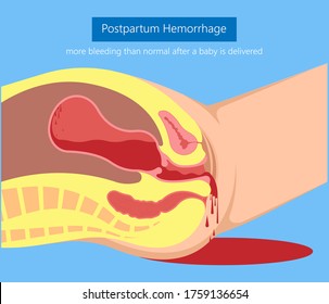 Postpartum Hemorrhage PPH Care Baby Loss Prevent Therapy Problem Vagina Period Lochia Mother Uterus Trauma Previa Atony Labor Blood Women Birth Treat Risk