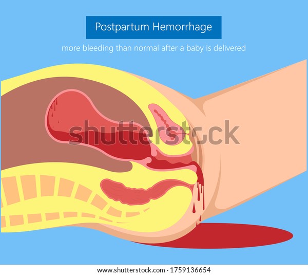 Postpartum hemorrhage PPH care baby loss\
Prevent therapy problem vagina period Lochia mother uterus trauma\
previa atony labor blood women birth treat\
Risk