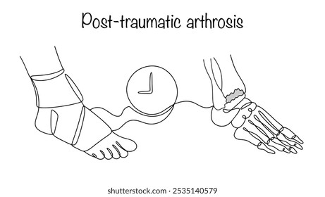 Artrose pós-traumática. Uma perna lesionada na qual, algum tempo após a lesão, se formou artrose da articulação. Uma ilustração de linha simples para uso no campo médico.