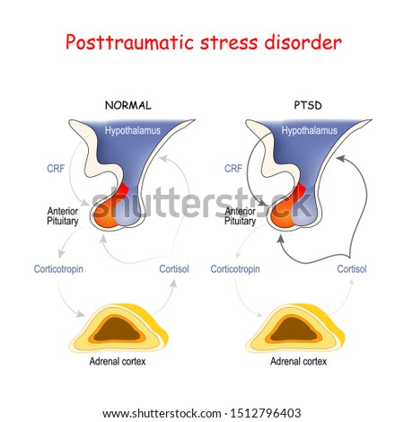 Posttraumatic stress disorder. Adrenal cortex, Anterior Pituitary and Hypothalamus. Regions of the brain associated with stress and PTSD. Endocrine Aspects: hypothalamic-pituitary-adrenal axis