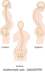 Postural defects vector. Diseases of the spine. Scoliosis, lordosis, swayback, slouch. Body posture defects. Spinal deformity types. Medical disease infographic. Diagnostic symptom.