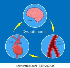 Postural Orthostatic Tachycardia Syndrome POTS Intolerance Tilt Table Test Dysautonomia Low Volume Diagnosed Measure Pulse Abnormal Fast Vessels Fainting Lightheadedness Dizziness Procedure Breathing