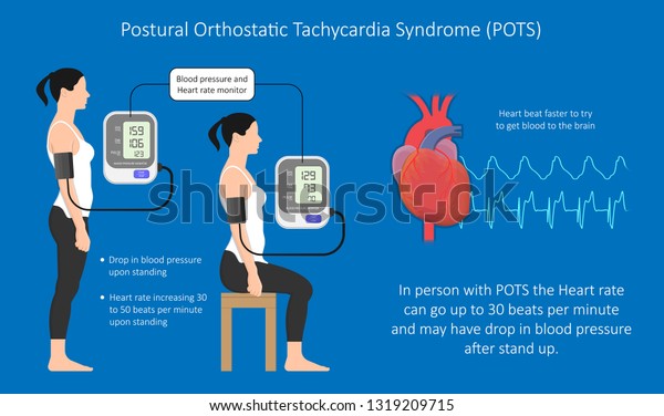 Postural Orthostatic Tachycardia Syndrome Pots Intolerance Stock Vector ...