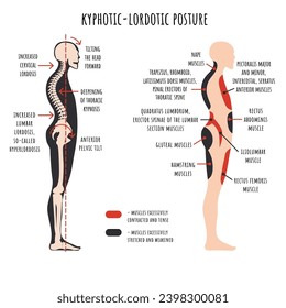 Trastornos de la postura infográfica. Postura clordotica kitrotica. La visión lateral muestra deformación de hombros redondeados e hiperlordosis, rotación pelvis, estirados y debilitados, acortados y decenas de músculos.