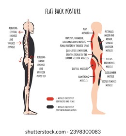 Posture disorders infographics. Flat back posture. The side view shows characteristic decrease natural curves of spine, pelvis rotation, stretched and weakened, shortened and tens muscles. Vector.