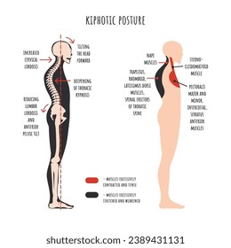 infografía de trastornos de la postura. Postura kypfótica. La vista lateral muestra deformación de hombros redondeados, curvatura de columna, rotación de pelvis, estirados y debilitados, acortados y decenas de músculos. Vector.