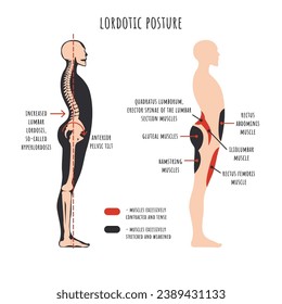 Posture disorders infographics. Lordotic posture. Side view shows hyperlordosis deformation, spine curvature, pelvis rotation, stretched and weakened, shortened and tens muscles. Vector illustration.