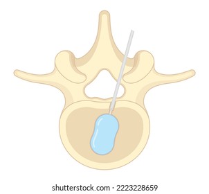 posture hunched back and vertebral column bone disk joint neck pain kyphoplasty spine of dowager’s hump disease surgical degeneration over backbone