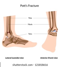 Pott's fracture