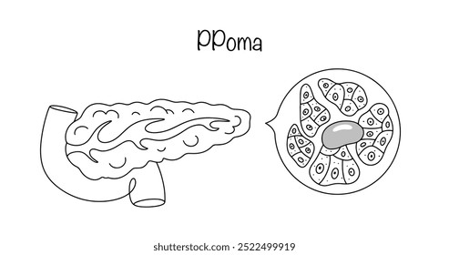 PPoma. Pancreatic islet tumor. A rare disease caused by the abnormal functioning of certain cells in the pancreas. Disruption of the human digestive system. Vector illustration.