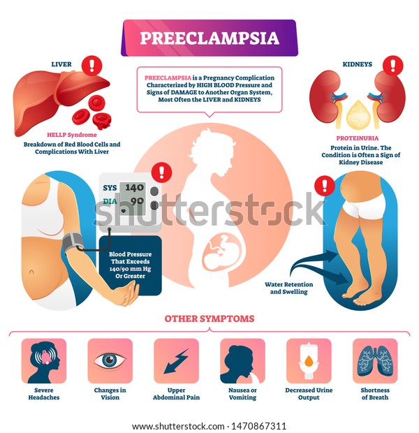 Preeclampsia Vector Illustration Labeled Pregnancy Complication Stock ...