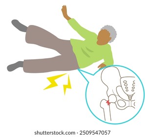 Local preferencial de fraturas de queda em idosos devido à osteoporose. Fratura da base do pé