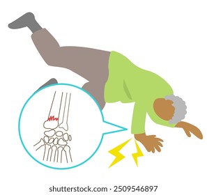 Preferred sites of fall fractures in the elderly due to osteoporosis. Wrist fractures
