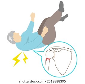 Sitios preferidos de fracturas por caída en los ancianos debido a osteoporosis. Fracturas del hombro