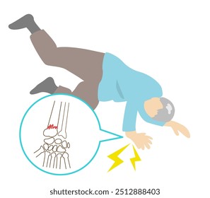 Preferred sites of fall fractures in the elderly due to osteoporosis. Wrist fractures