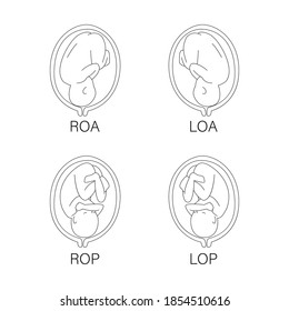 Pregnancy - Different Positions of Baby in the Womb. Fetus Positions In Uterus