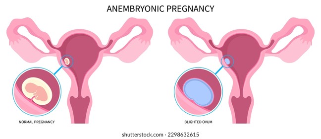 pregnancy loss missed abortion with Blighted ovum of anembryonic ectopic empty egg molar conception fertilization miscarriage and early first Natural