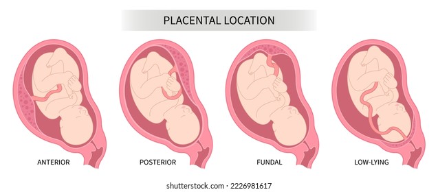 Pregnancy prenatal care and uterine wall growth restriction with baby Lateral placenta location back fetus Labour death intrauterine gender prediction