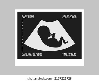 Pregnancy ultrasound black and white picture. Baby in the womb. Little baby silhouette medical photo. Pregnant woman clinic examination. Embryo human vector illustration. Sonography test. Belly scan