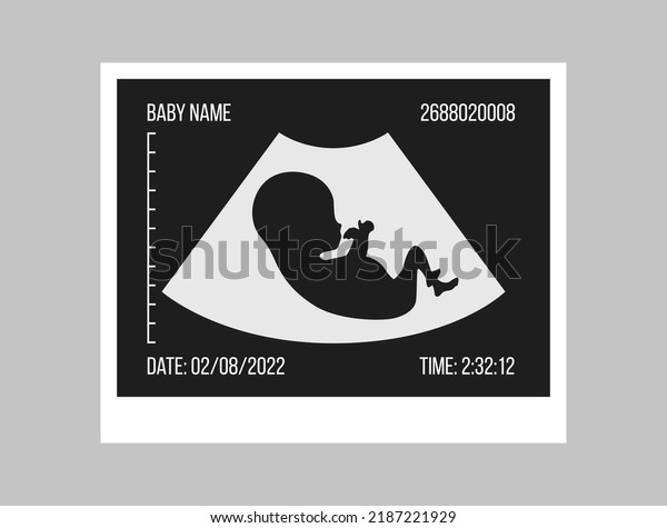 Pregnancy ultrasound black and white picture. Baby\
in the womb. Little baby silhouette medical photo. Pregnant woman\
clinic examination. Embryo human vector illustration. Sonography\
test. Belly scan