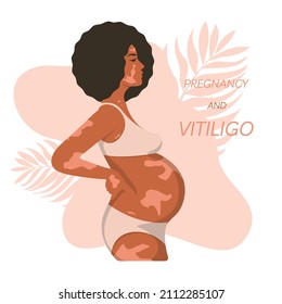 Pregnant black woman with vitiligo. An African woman with pigmentation on her skin, in underwear, stands and supports her lower back with her hand. Pregnancy and vitiligo. Vector illustration.