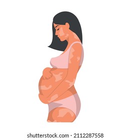 A pregnant, swarthy, dark-haired woman with vitiligo spots on her skin, hugs her big belly with her hands. Vector illustration, flat cartoon color design, isolated on white background, eps 10.