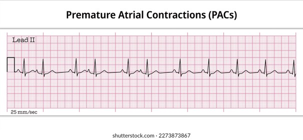 Frühzeitige Vorversionskontraktionen (PAC) - Vorreifer Behandlungskomplex (PAC) - 8 zweites ECG-Papier - Elektrokardiographische Vektormedizinische Illustration