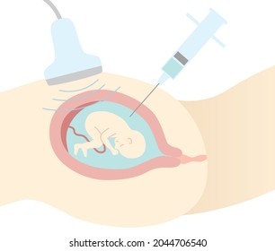 Prenatal diagnosis. Amniocentesis. An illustration of a pregnant woman's stomach seen from the side. Flat design.